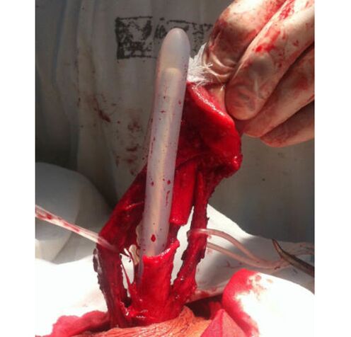 عضو تناسل کو بڑا کرنے کے لیے پٹھوں کے ٹشو کی پیوند کاری